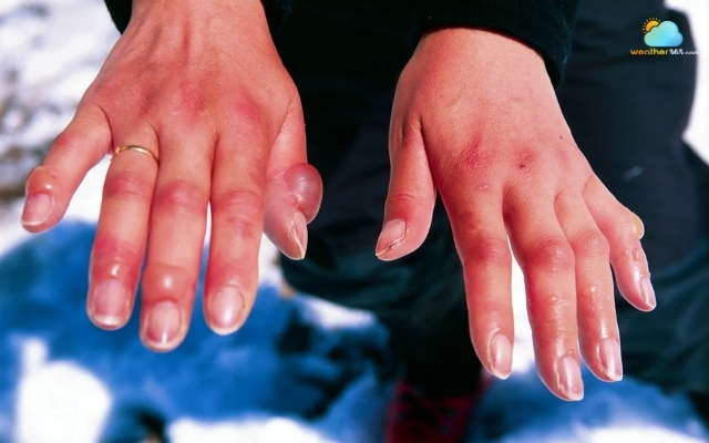 Wind chill increases the likelihood of frostbite