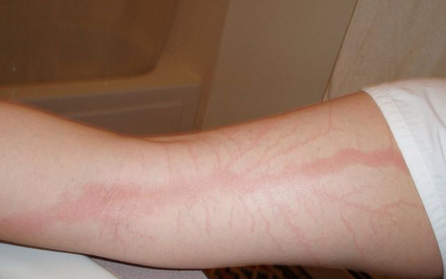 Lichtenberg figures due to lightning strikes