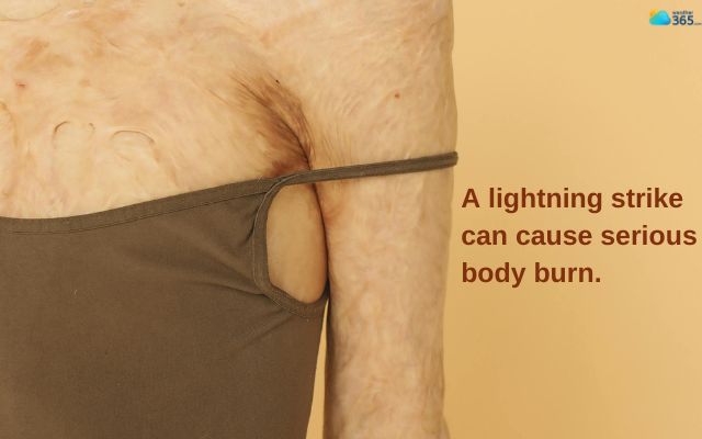  Body burn due to a lightning strike